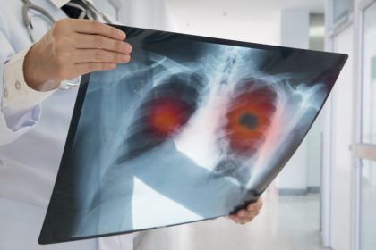 lungs xray_Dietitians On Demand