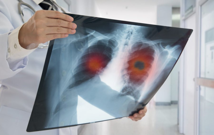 lungs xray_Dietitians On Demand