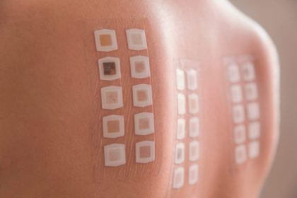 Allergy patch test_Dietitians On Demand