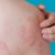 Stevens-Johnson Syndrome and Toxic Epidermal Necrolysis