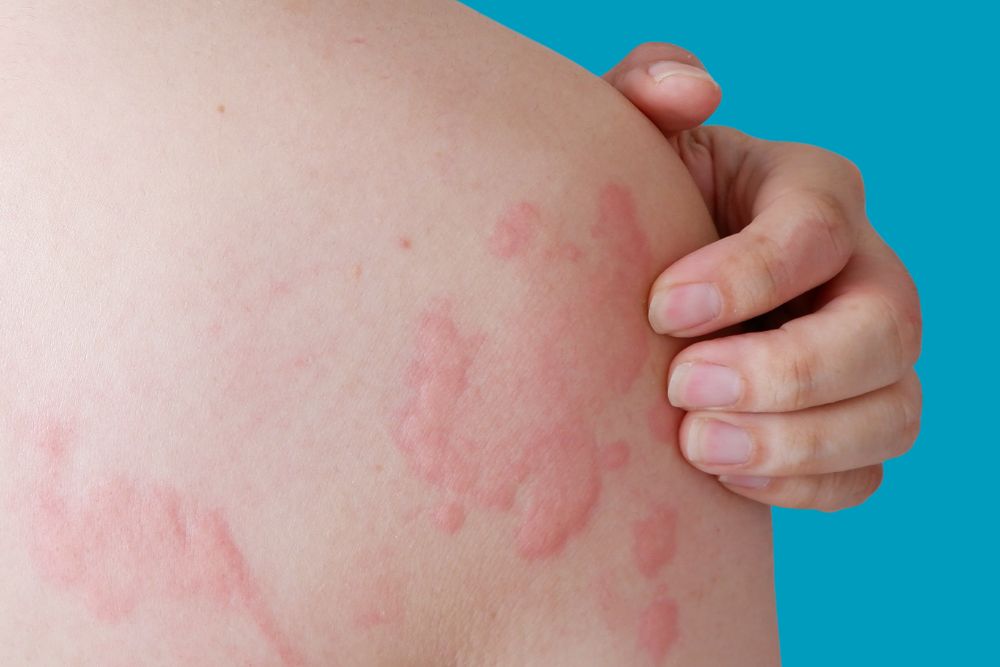 Stevens-Johnson Syndrome and Toxic Epidermal Necrolysis